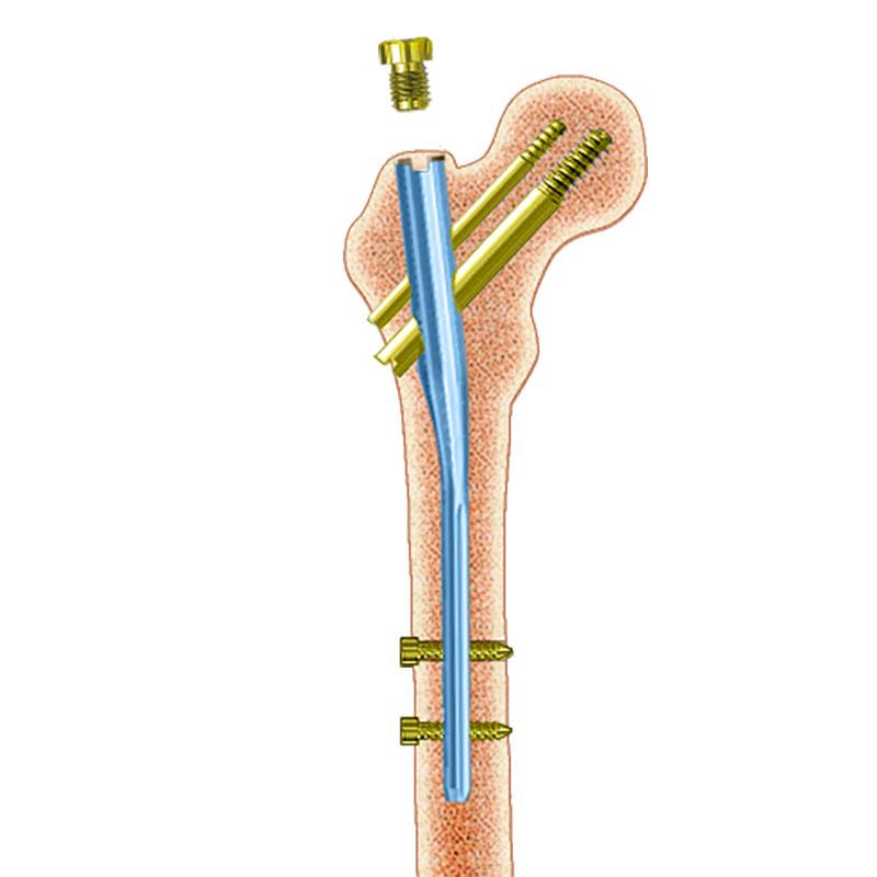 Стержень вертлюговий для інтрамедулярного остеосинтезу стегнової кістки ChFN подовжений
